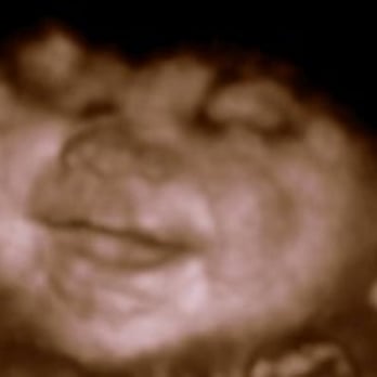 Stork Snapshots - That tickles! - Ultrasound Imaging Centers Near Me - Lombard, Illinois Stork Snapshots - That tickles! - Ultrasound Imaging Centers Near Me - Lombard, Illinois
