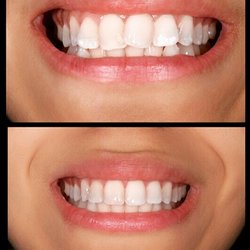 SDDS Dental - Before and after Invisalign (1 year)