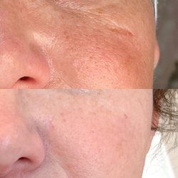 Hello Beautiful Medical Spa - Scar visible in top picture and gone with bottom after Morphius 8 ( 3 treatments) with Larkyn.