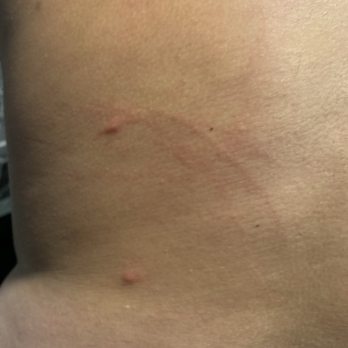 Havana Cabana - Bed bug bites - Resorts Near Me - Key West, Florida Havana Cabana - Bed bug bites - Resorts Near Me - Key West, Florida
