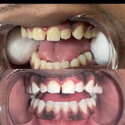 60 Minute Teeth Whitening Session