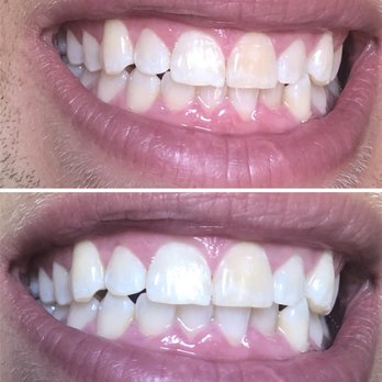 WhiteNow - Our patient after 1 WhiteNow Level 1 treatment session. - Teeth Whitening Near Me - Dallas, Texas WhiteNow - Our patient after 1 WhiteNow Level 1 treatment session. - Teeth Whitening Near Me - Dallas, Texas