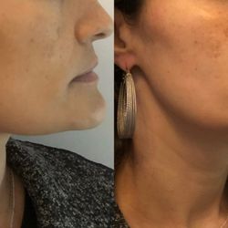 New Image Body and Face Contouring - Thermalift(RF) & Ultralift rebuilds collagen, while lifting & tightening the underlined muscles in the face. -Alternative to botox & fillers