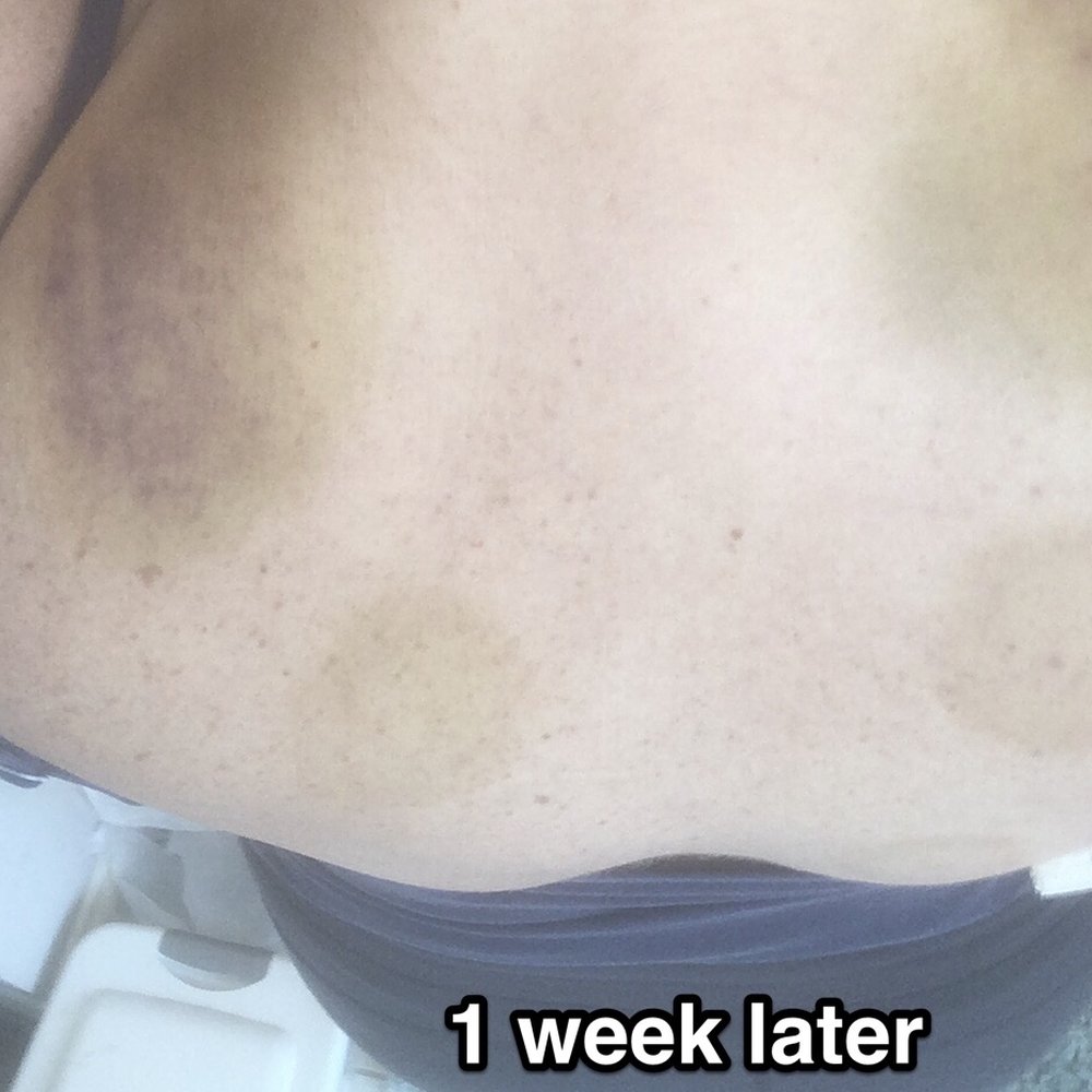 ATL Massage - 1 week later, back cupping, - Massage Near Me - Dacula, Georgia ATL Massage - 1 week later, back cupping, - Massage Near Me - Dacula, Georgia