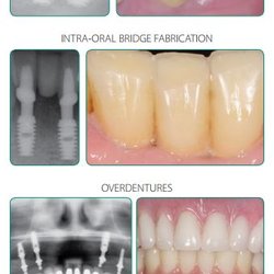 WhiteCrest Smart Dentistry - Implants for single & multiple crowns, intra oral bridge, overdentures & full mouth restorations