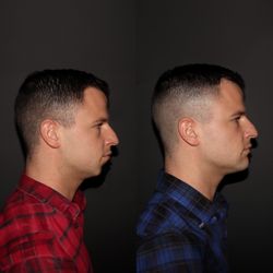 Mara's Med Spa-Uptown - This before and after shows the results of chin enhancement, improving facial balance and definition with a subtle yet effective transformat