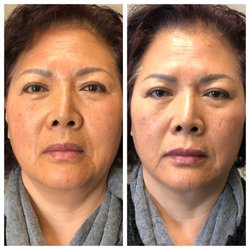 LMG School of Aesthetic Injecting - Botox and Fillers