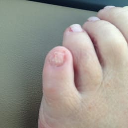 This is the toenail that the tech ripped off and then yelled at ME because I complained!!! This is the toenail that the tech ripped off and then yelled at ME because I complained!!!