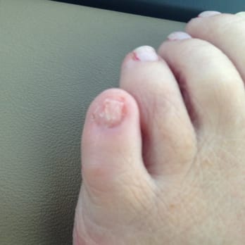 Crystal Nails - This is the toenail that the tech ripped off and then yelled at ME because I complained!!! - Nail Salons Near Me - Ventura, California Crystal Nails - This is the toenail that the tech ripped off and then yelled at ME because I complained!!! - Nail Salons Near Me - Ventura, California