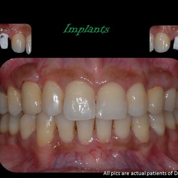 The Center - Where are the implants????? - General Dentistry Near Me - Annandale, Virginia The Center - Where are the implants????? - General Dentistry Near Me - Annandale, Virginia