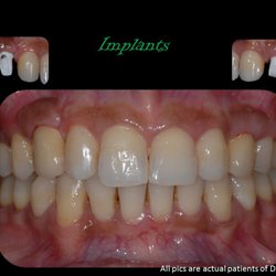 Mark Egber DDS - Center for Dentofacial Aesthetics - Where are the implants?????