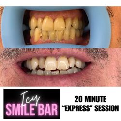 Icy Smile Bar - Express whitening session