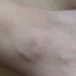 Ego Beauty & Wellness Defined - Bruise,