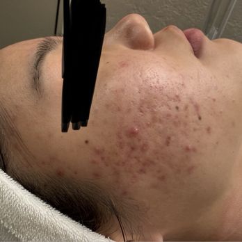 Acne Solutions Skin Care & Spa - before - Acne Treatment Near Me - Upland, California Acne Solutions Skin Care & Spa - before - Acne Treatment Near Me - Upland, California