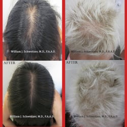 ProDerm Image - General and Cosmetic Dermatology - Results after one single Platelet Rich Plasma (PRP) Injection Therapy
