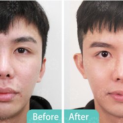 Platelet Rich Fibrin - PRF tear trough injection and facial microneedling