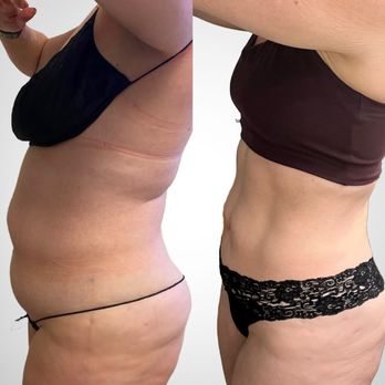 Rejuven8 OC - Are you on a weightloss journey? Find out how Brazilian Lymphatic + Body Sculpting can enhance your results. - Body Contouring Near Me - Newport Beach, California Rejuven8 OC - Are you on a weightloss journey? Find out how Brazilian Lymphatic + Body Sculpting can enhance your results. - Body Contouring Near Me - Newport Beach, California