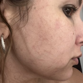 Body Sculpt Skin Laser - My face is ruined from this place. - Medical Spas Near Me - Vienna, Virginia Body Sculpt Skin Laser - My face is ruined from this place. - Medical Spas Near Me - Vienna, Virginia