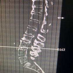 Wilson Chiropractic - Spinal degeneration comes in degrees.