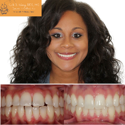Keith B. Wong, DDS MS - Before and after patient pictures using Invisalign!