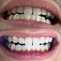 Ultra Chic Whitening - Before & After