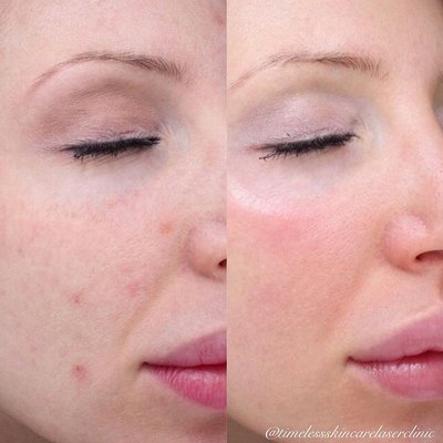 timeless skin care laser clinic