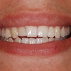 Ryoo Dental - After bridge treatment