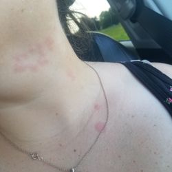 Red Carpet Inn - Bites from bugs