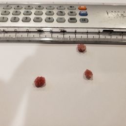 Stones from my kitty that they helped remove