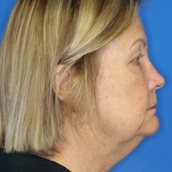 Robert J Paresi,  MD - 69 year-old patient before facelift