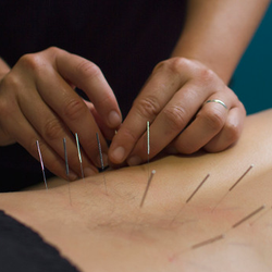 Limitless Physical Therapy - Dry Needling