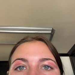 Brazilian Wax By Andreia - Burn marks and swollen eye