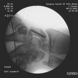 Lamont J Cardon, MD - My scaphoid as fixed by Cardon in 2012.
