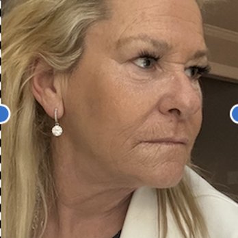 Dr Francine Fradella - AFTER FACETITE   Thank youDr. Fradella - Obstetricians & Gynecologists Near Me - Massapequa, New York