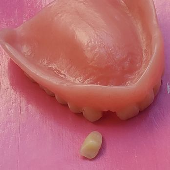 Aspen Dental - Albany, GA - Denture with tooth that fell out. - General Dentistry Near Me - Albany, Georgia Aspen Dental - Albany, GA - Denture with tooth that fell out. - General Dentistry Near Me - Albany, Georgia