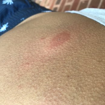 Great Wolf Lodge - Bites on my abdomen - Water Parks Near Me - Gurnee, Illinois Great Wolf Lodge - Bites on my abdomen - Water Parks Near Me - Gurnee, Illinois