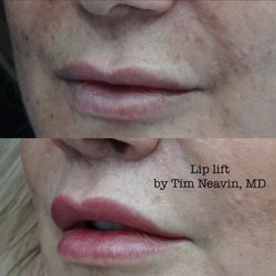 Tim Neavin - Plastic surgeon Santa Barbara - 6 months after lip lift.