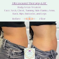 Nirvana Wellness & MedSpa - RF and Ultrasound cavitation, followed by lymph drainage, loose inches of fat and tighten skin without surgery!