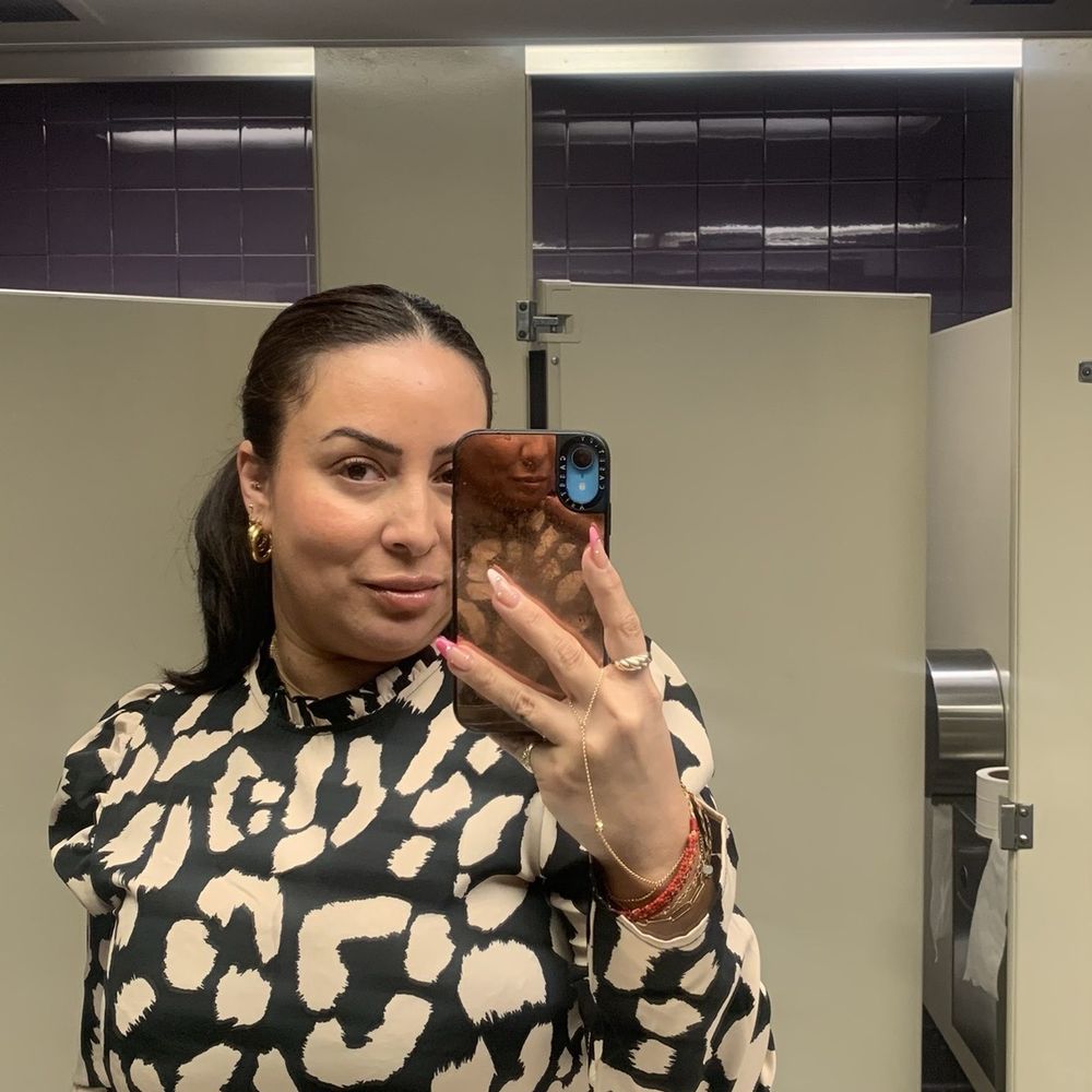 Iconic Skin Clinic- Downey - SkinVive done in February 2024 (Photo taken April 2024) - Medical Spas Near Me - Downey, California Iconic Skin Clinic- Downey - SkinVive done in February 2024 (Photo taken April 2024) - Medical Spas Near Me - Downey, California