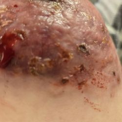 Research Medical Center - This is my pain sight. I'm not faking. This photo has a time stamp on it for proof.