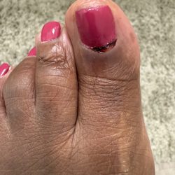 Nailscape - Injured left toe.