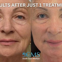 Before-and-after results showing improved skin tone, texture, fine lines, and firmness after one Laser-Coring™ treatment.