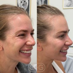 Glamour By Gaby - Dysport before and after