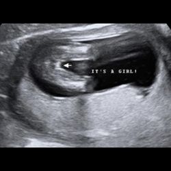 Maternal Memories 3D 4D Ultrasound - Gender reveal 14+ weeks! It's a girl!
