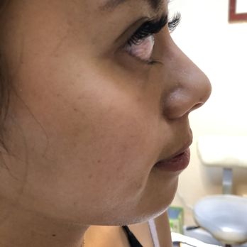 Beauty By Lana - After - Skin Care Near Me - Newark, California Beauty By Lana - After - Skin Care Near Me - Newark, California