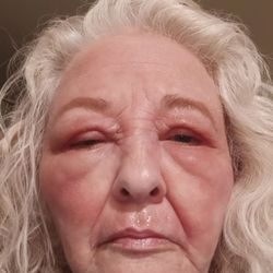 Cedars-Sinai Medical Center - My face on Friday morning