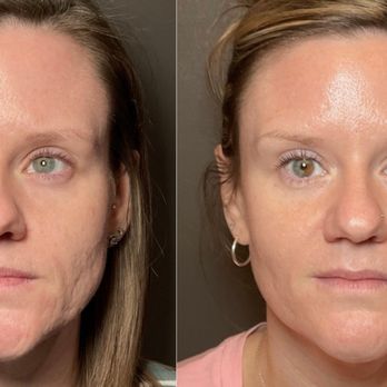 Physician Aesthetic Specialists - Radio frequency micro-needling,& NouvaDerm combo stacked treatment. - Medical Spas Near Me - Lenexa, Kansas Physician Aesthetic Specialists - Radio frequency micro-needling,& NouvaDerm combo stacked treatment. - Medical Spas Near Me - Lenexa, Kansas