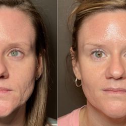 Physician Aesthetic Specialists - Radio frequency micro-needling,& NouvaDerm combo stacked treatment.