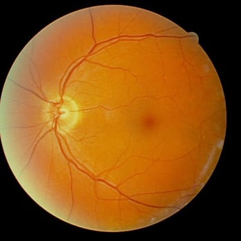 Cary Family Eye Care - Advanced diagnostic imaging - Eyewear & Opticians Near Me - Cary, North Carolina Cary Family Eye Care - Advanced diagnostic imaging - Eyewear & Opticians Near Me - Cary, North Carolina