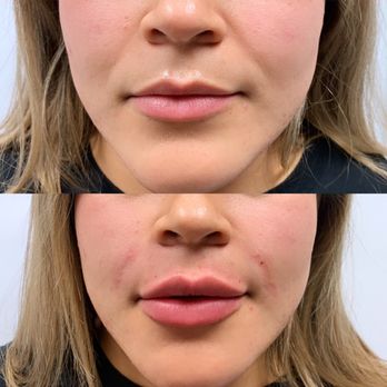MedSkinEssentials - Lip and smile line filler - Medical Spas Near Me - Tustin, California MedSkinEssentials - Lip and smile line filler - Medical Spas Near Me - Tustin, California